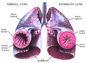 Asthma – Dr. Molly's